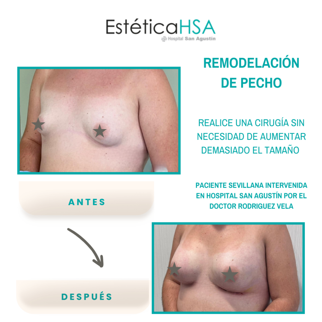 PROMOCION PECHO HOSPITAL SAN AGUSTIN_ESTETICA