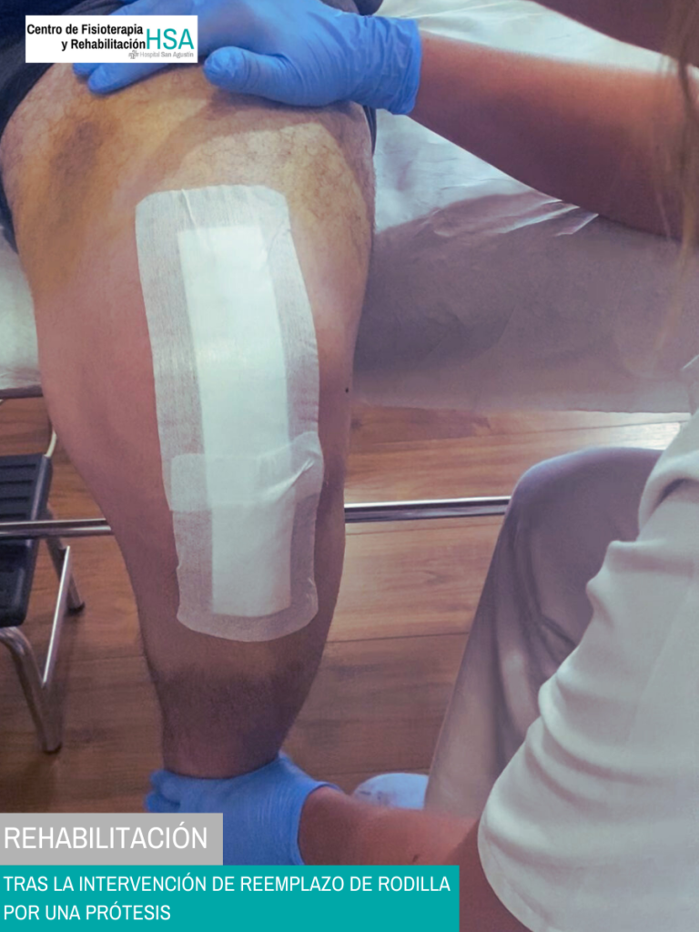 Rehabilitación tras la intervención de reemplazo de rodilla por una prótesis_HOSPITAL SAN AGUSTÍN SEVILLA_02_vertical