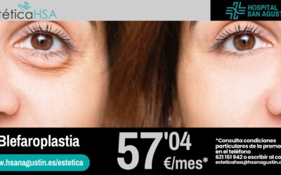 Blefaroplastia: Rejuvenece tu mirada con nuestra promoción en Estética HSA