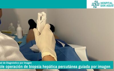 Doble operación de biopsia hepática percutánea guiada por imagen en Hospital San Agustín